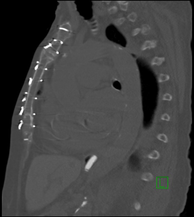 Amiodarone deposition in the liver (Radiopaedia 77587-89780 Sagittal bone window 45).jpg