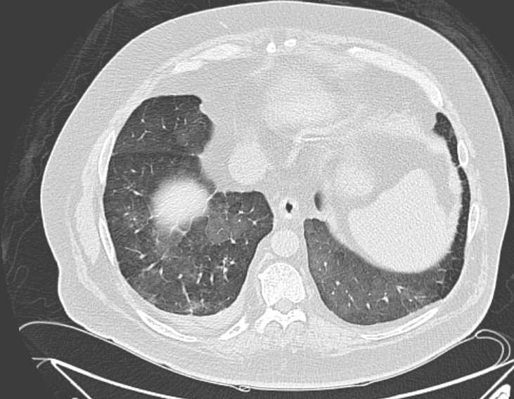 File:Amiodarone lung (Radiopaedia 62514-70769 Axial lung window 69).jpg