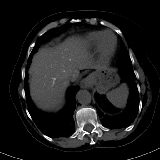 File:Ampullary adenocarcinoma (Radiopaedia 34013-35241 AXIAL THICK 11).png