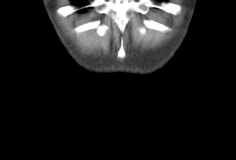 Ampullary adenocarcinoma (Radiopaedia 34013-35241 Coronal 54).png