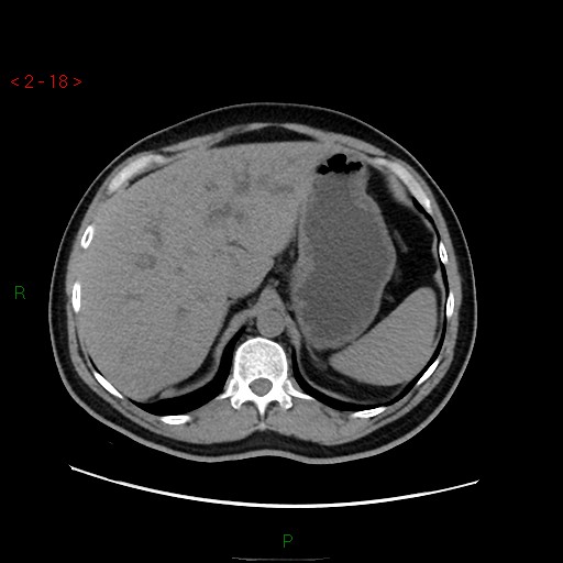 File:Ampullary carcinoma (Radiopaedia 56396-63056 Axial non-contrast 12).jpg