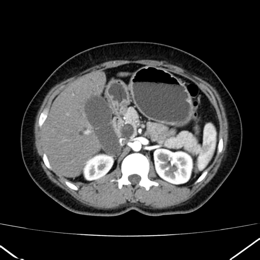 Ampullary tumor (Radiopaedia 22787-22816 B 31).jpg
