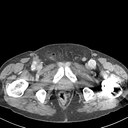File:Amyand hernia (Radiopaedia 39300-41547 A 76).png