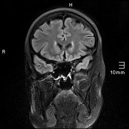 File:Amyotrophic lateral sclerosis (Radiopaedia 70821-81017 Coronal FLAIR 10).jpg