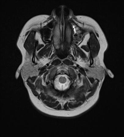 File:Anaplastic astroblastoma (Radiopaedia 55666-62194 Axial T2 2).png