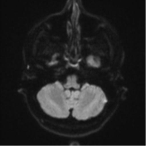 File:Anaplastic astrocytoma (Radiopaedia 57768-64731 Axial DWI 33).png