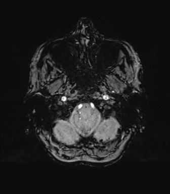 Anaplastic astrocytoma (Radiopaedia 86943-103160 Axial SWI 15).png