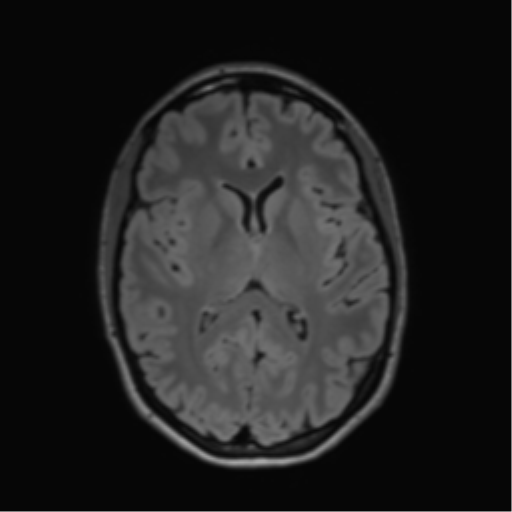 File:Anaplastic astrocytoma IDH mutant (Radiopaedia 50046-55341 Axial FLAIR 27).png