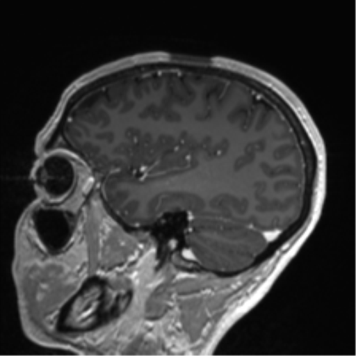 Anaplastic astrocytoma IDH mutant (Radiopaedia 50046-55341 Sagittal T1 C+ 46).png