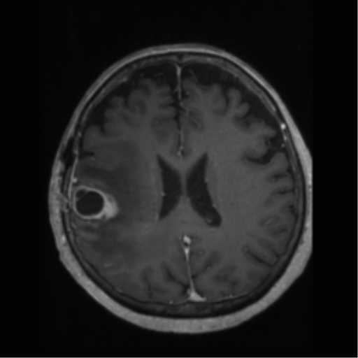 File:Anaplastic astrocytoma IDH wild-type (pseudoprogression) (Radiopaedia 42209-45277 Axial T1 C+ 79).png