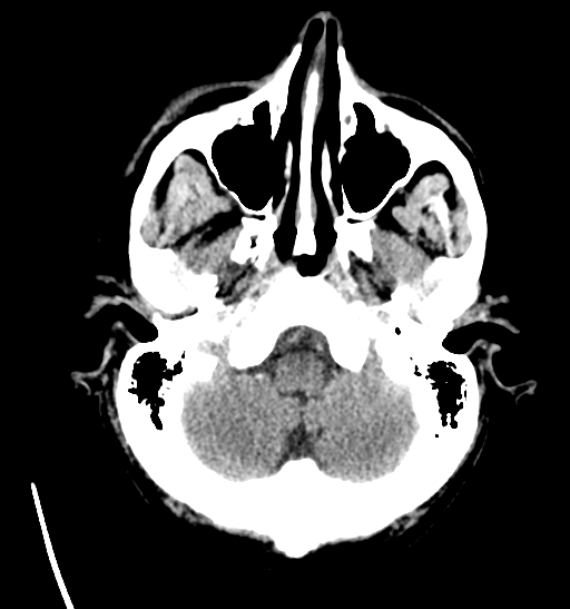 File:Anaplastic meningioma with recurrence (Radiopaedia 34452-35786 Axial non-contrast 6).png