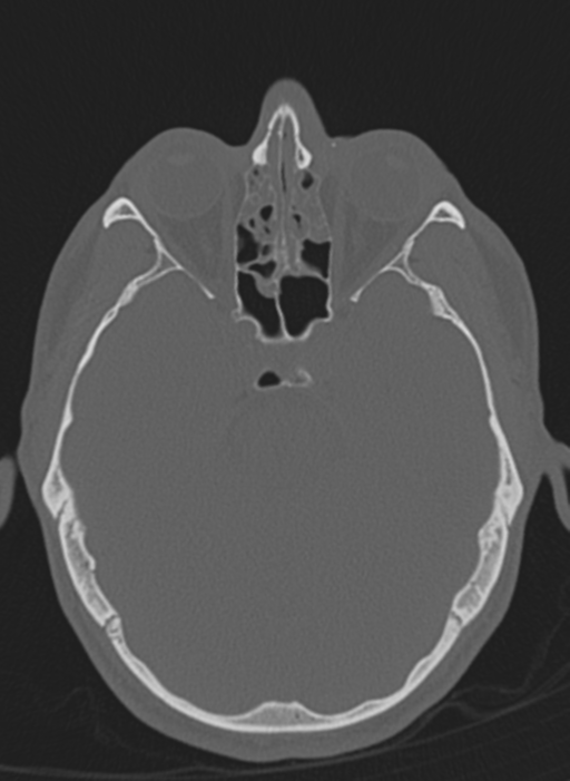 Anaplastic oligodendroglioma with skull fracture (Radiopaedia 74831-85846 Axial bone window 50).png