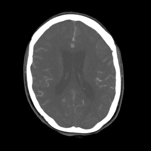 Aneursym related subarachnoid hemorrhage with hydrocephalus (Radiopaedia 45105-49084 A 39).jpg