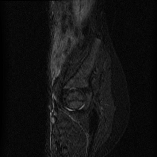File:Aneurysmal bone cyst - sacrum (Radiopaedia 65190-74196 Sagittal STIR 7).jpg
