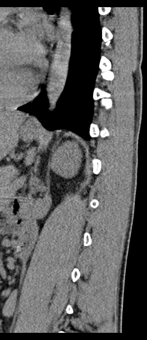 Aneurysmal bone cyst T11 (Radiopaedia 29294-29721 E 20).jpg