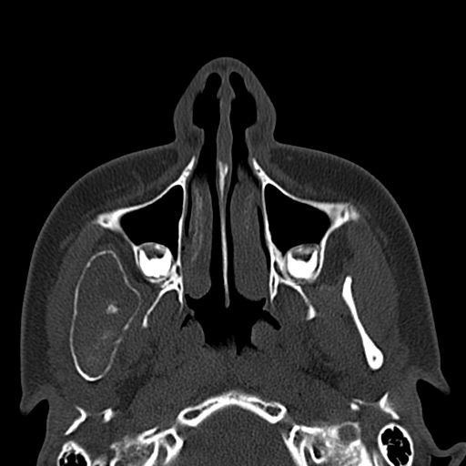 Aneurysmal bone cyst of the mandible (Radiopaedia 43280-46601 Axial bone window 62).jpg