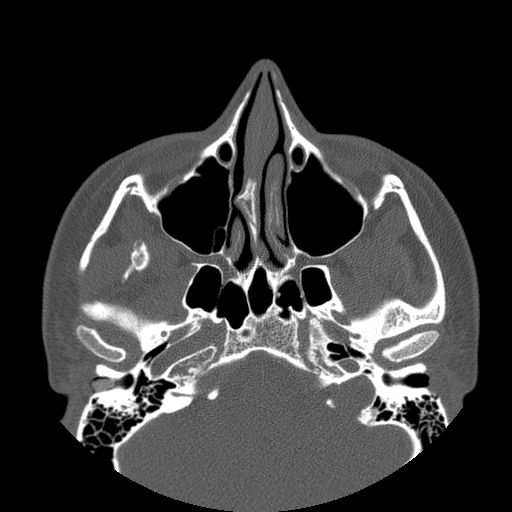 Aneurysmal bone cyst of the mandible (Radiopaedia 43280-46823 Axial bone window 142).jpg