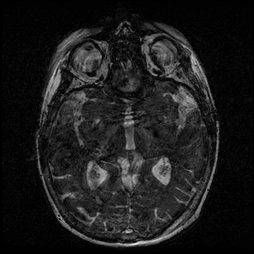 Angioinvasive aspergillosis in the pituitary fossa (Radiopaedia 39676-42010 Ax 3D FIESTA VOLUME 87).png