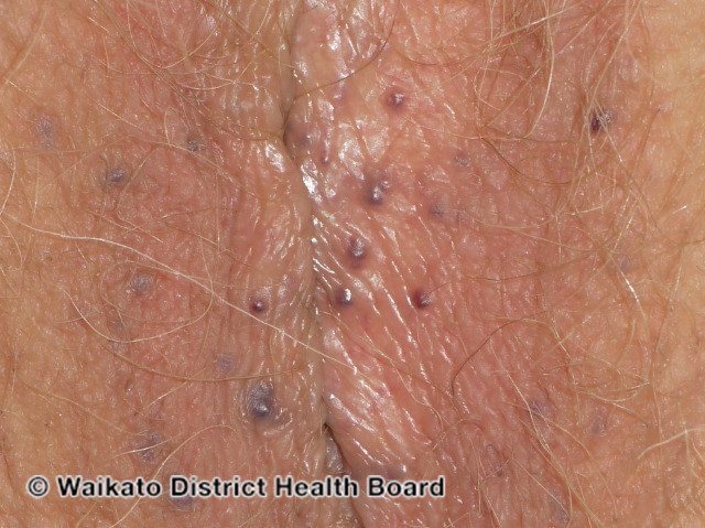 File:Angiokeratoma of Fordyce on vulva (DermNet NZ angiokeratoma-28).jpg