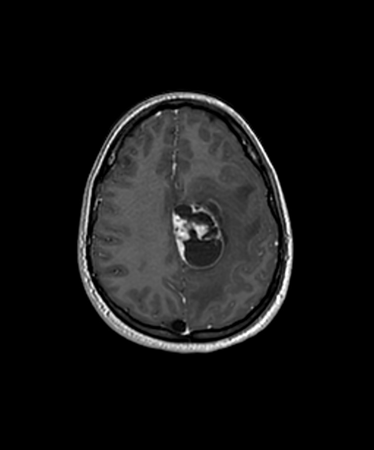 Angiomatous meningioma (Radiopaedia 79459-92577 Axial T1 C+ 3D ISO 32).jpg