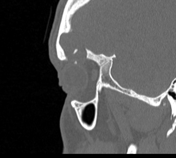 Angular epidermoid cyst (Radiopaedia 46908-51439 Sagittal bone window 81).png