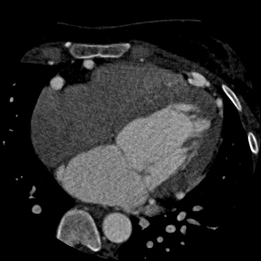 File:Anomalous left coronary artery from the pulmonary artery (ALCAPA) (Radiopaedia 40884-43586 A 45).jpg