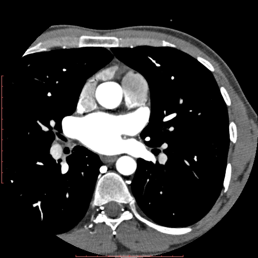 Anomalous left coronary artery from the pulmonary artery (ALCAPA) (Radiopaedia 70148-80181 A 72).jpg