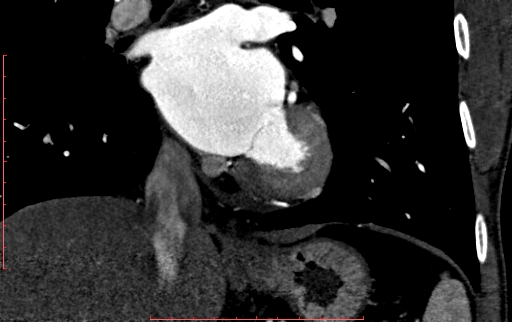 Anomalous left coronary artery from the pulmonary artery (ALCAPA) (Radiopaedia 70148-80181 B 202).jpg