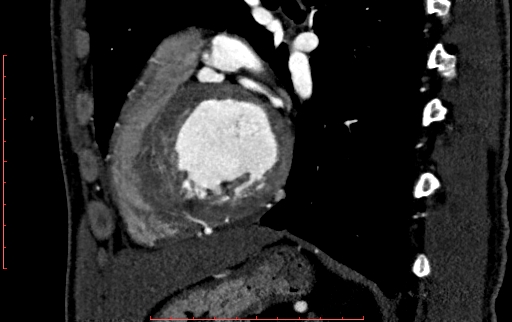 File:Anomalous left coronary artery from the pulmonary artery (ALCAPA) (Radiopaedia 70148-80181 C 169).jpg