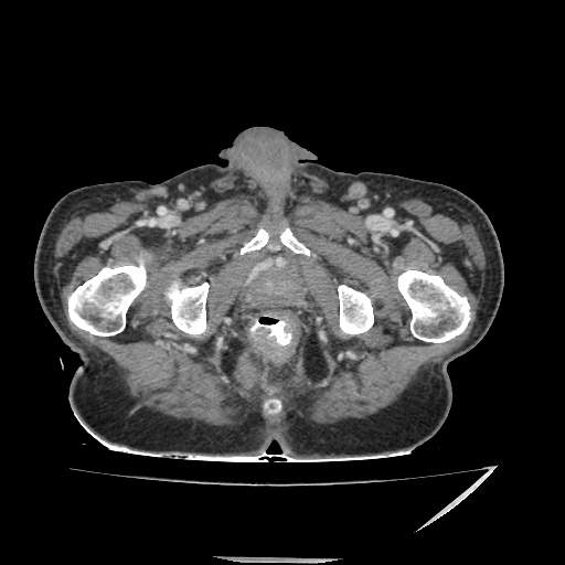 Anorectal carcinoma (Radiopaedia 44413-48064 A 56).jpg