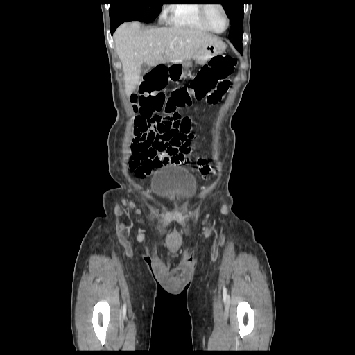 Anorectal carcinoma (Radiopaedia 44413-48064 B 4).jpg