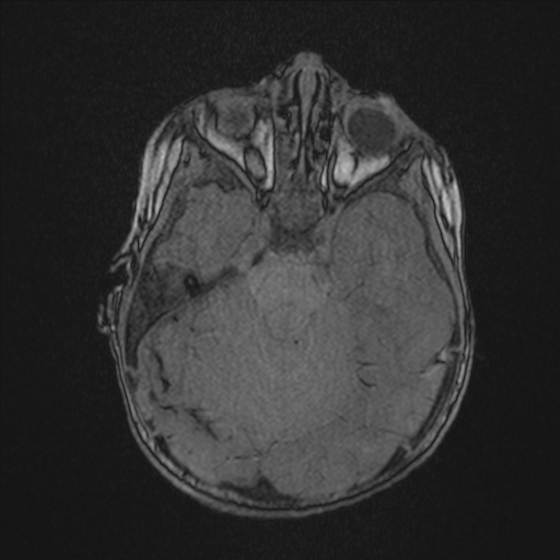 Anoxic brain injury (Radiopaedia 79165-92139 Axial MRA 70).jpg