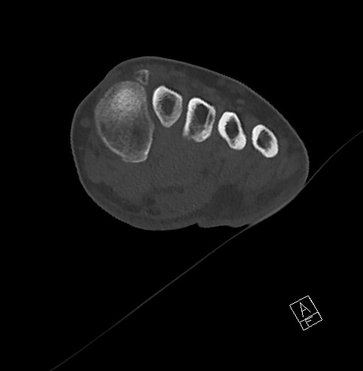 Anterior calcaneal process fracture (Radiopaedia 63353-71943 Axial bone window 68).jpg
