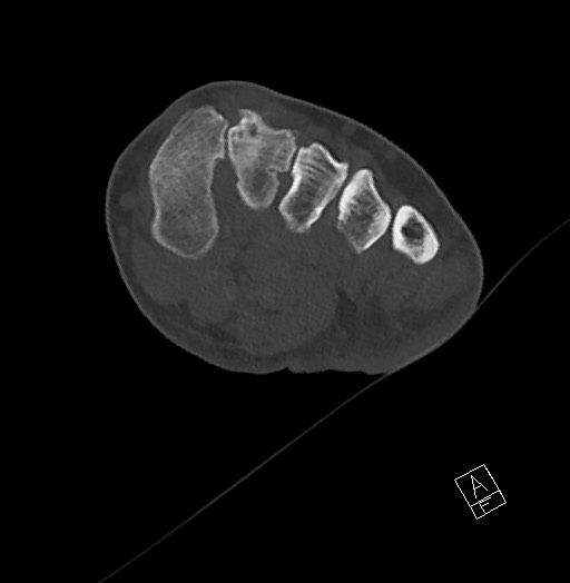 Anterior calcaneal process fracture (Radiopaedia 63353-71943 Axial bone window 72).jpg
