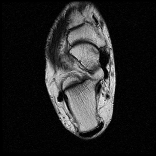File:Anterior calcaneal process fracture (Radiopaedia 71377-81705 Axial T2 10).jpg