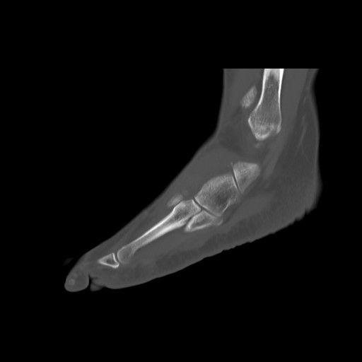 File:Anterior calcaneal process fracture (Radiopaedia 82590-96762 Sagittal bone window 21).jpg