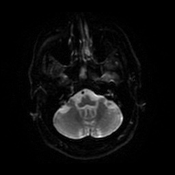 Anterior cerebral artery infarction (Radiopaedia 46794-51323 Axial DWI 34).jpg
