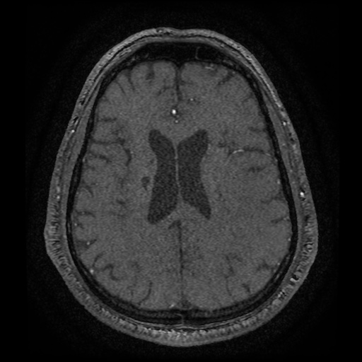 Anterior cerebral artery infarction (Radiopaedia 46794-51323 Axial MRA 147).jpg