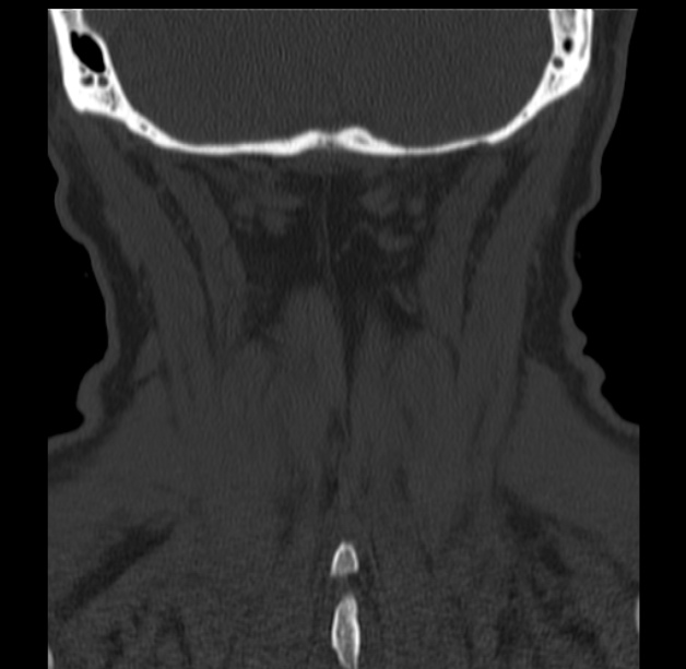 Anterior cervical postdiscectomy arthrodesis (Radiopaedia 32678-33646 Coronal bone window 63).jpg