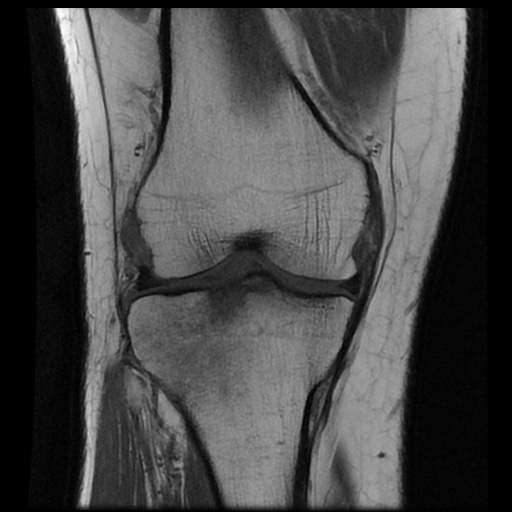 File:Anterior cruciate ligament avulsion fracture (Radiopaedia 58939-66193 Coronal T1 10).jpg