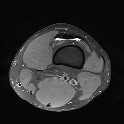 File:Anterior cruciate ligament full thickness tear (Radiopaedia 66268-75467 Axial PD fat sat 1).jpg
