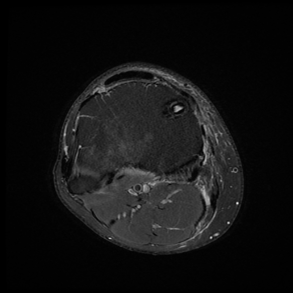 File:Anterior cruciate ligament graft tear and bucket-handle tear of medial meniscus (Radiopaedia 75867-87255 Axial PD fat sat 2).jpg