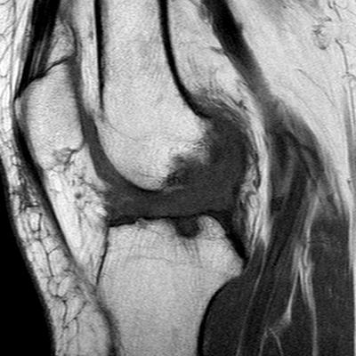 File:Anterior cruciate ligament mucoid degeneration (Radiopaedia 60853-68633 Sagittal T1 45).jpg