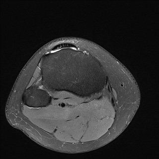 File:Anterior cruciate ligament rupture and posteromedial corner injury (Radiopaedia 67338-76723 Axial 29).jpg