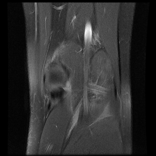 File:Anterior cruciate ligament tear (Radiopaedia 61500-69462 Coronal PD fat sat 18).jpg