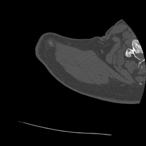 Anterior glenohumeral dislocation with Hill-Sachs lesion (Radiopaedia 62877-71249 Axial bone window 4).jpg
