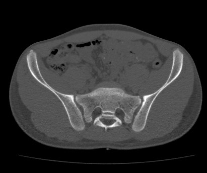 Anterior inferior iliac spine avulsion fracture (Radiopaedia 81312-94999 Axial bone window 28).jpg