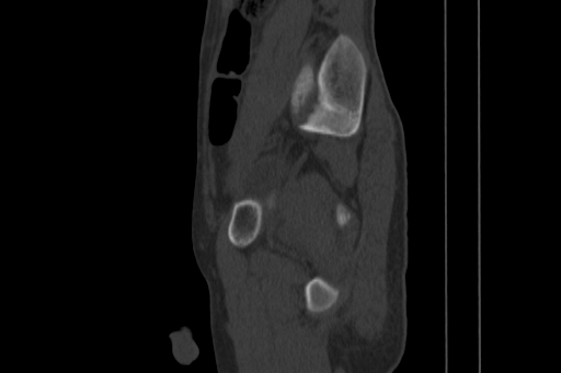 Anterior inferior iliac spine avulsion injury (Radiopaedia 88666-105376 Sagittal bone window 66).jpg