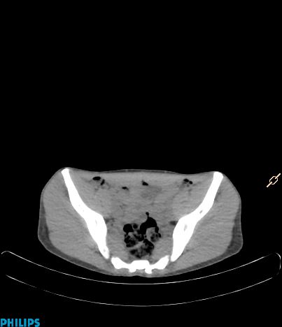 File:Anterior mediastinal seminoma (Radiopaedia 80270-93613 C 44).jpg
