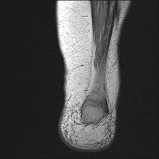 File:Anterior talofibular ligament injury - rupture with soft-tissue impingement (Radiopaedia 38765-40928 Coronal PD 3).jpg